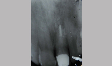 Dental jewellery treatment in Anand                        